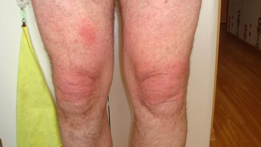 Belauneko artikulazioen artrosia